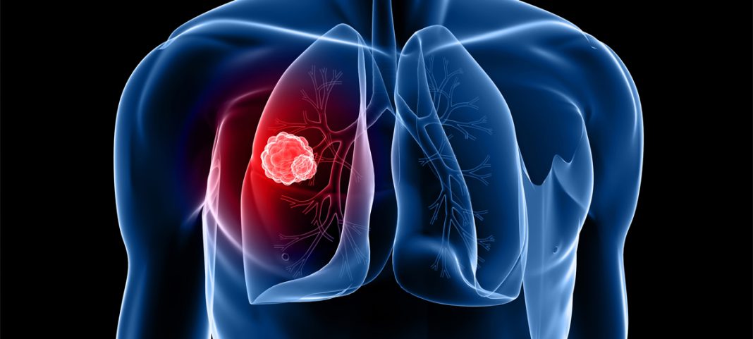 60 a 70% dos diagnósticos de cancro do pulmão são feitos numa fase avançada